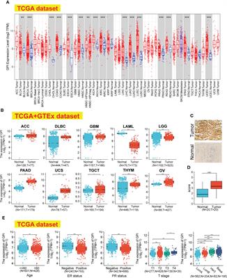 GPI: An indicator for immune infiltrates and prognosis of human breast cancer from a comprehensive analysis